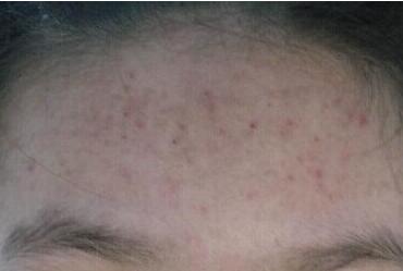 辉县青春痘有哪些症状特点呢?