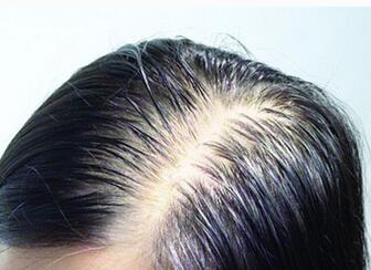 出现脱发病有什么原因?辉县脱发医院