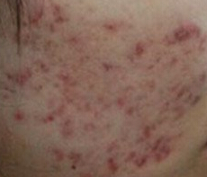 辉县治疗青春痘好的医院