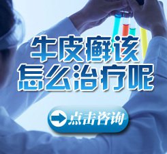 辉县牛皮癣医院