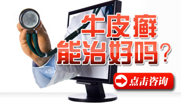 辉县牛皮癣医院
